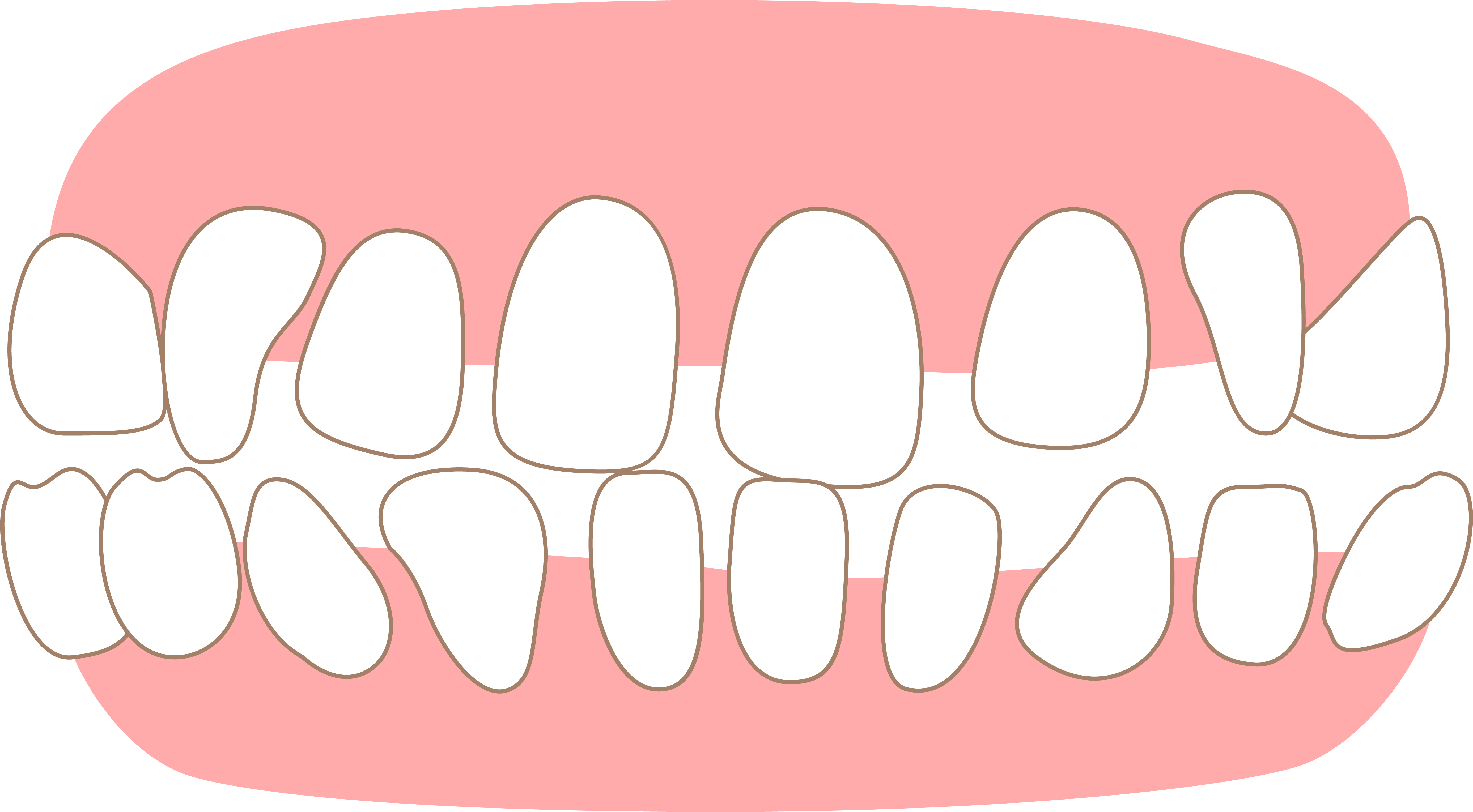 すきっ歯(空隙歯列)
